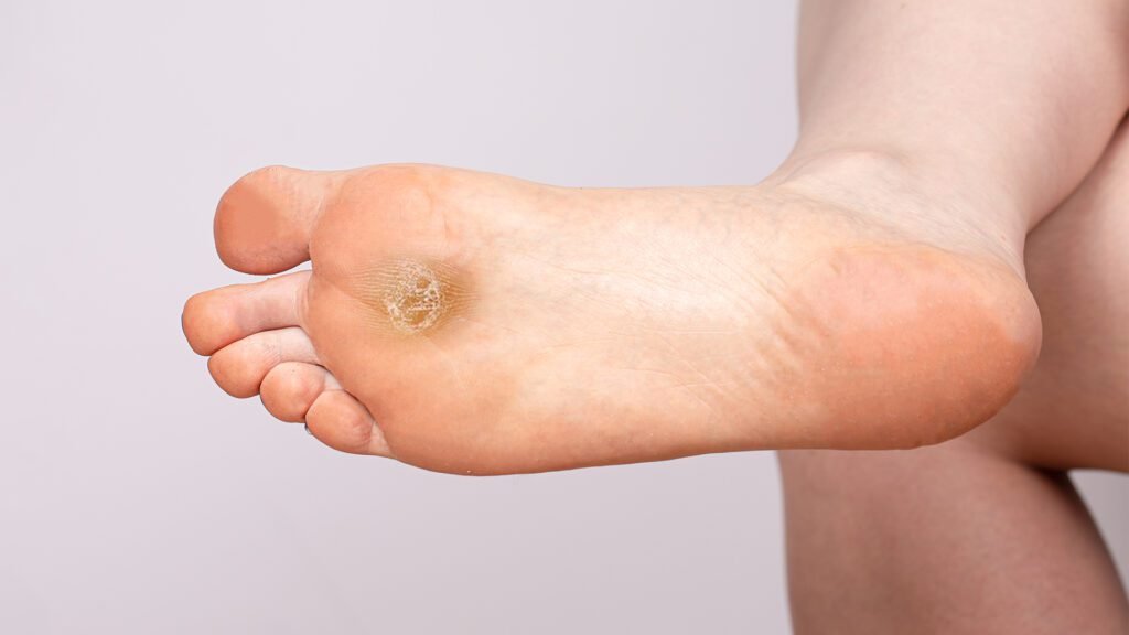 Pé acometido com calosidade