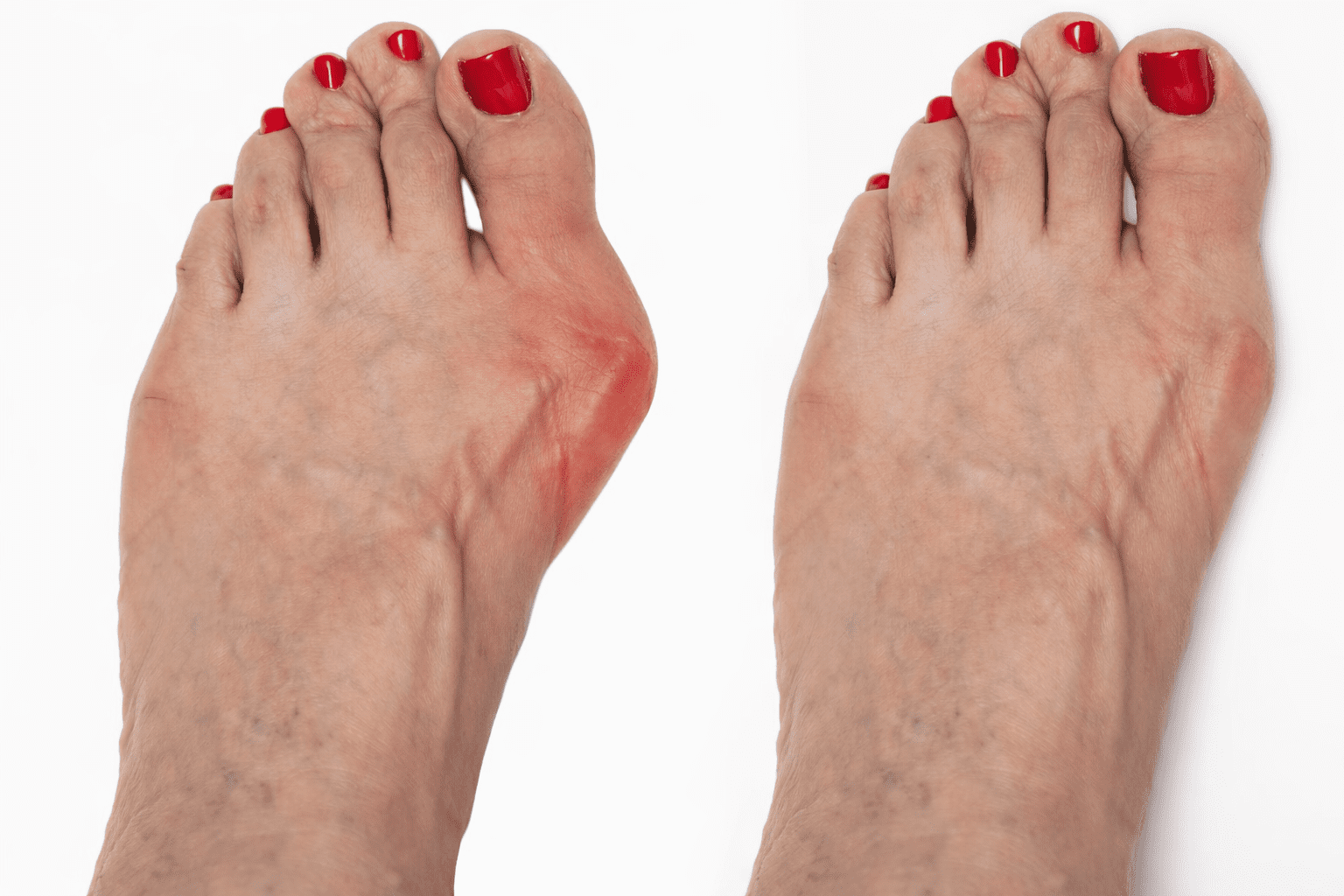 Antes e depois de pé com joanete