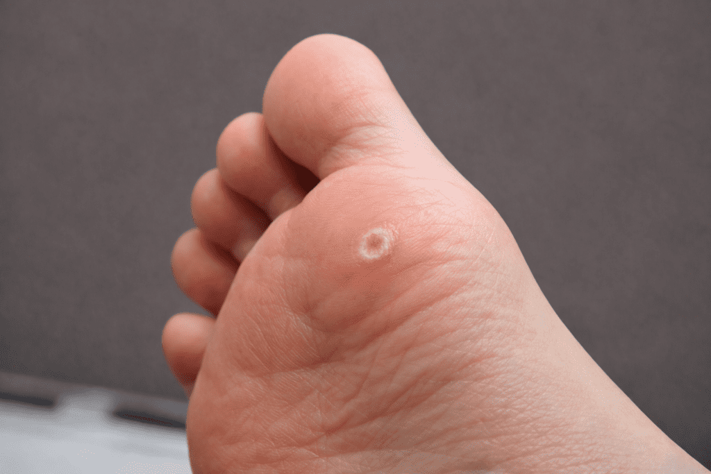 Pé acometido com verruga plantar (olho de peixe)