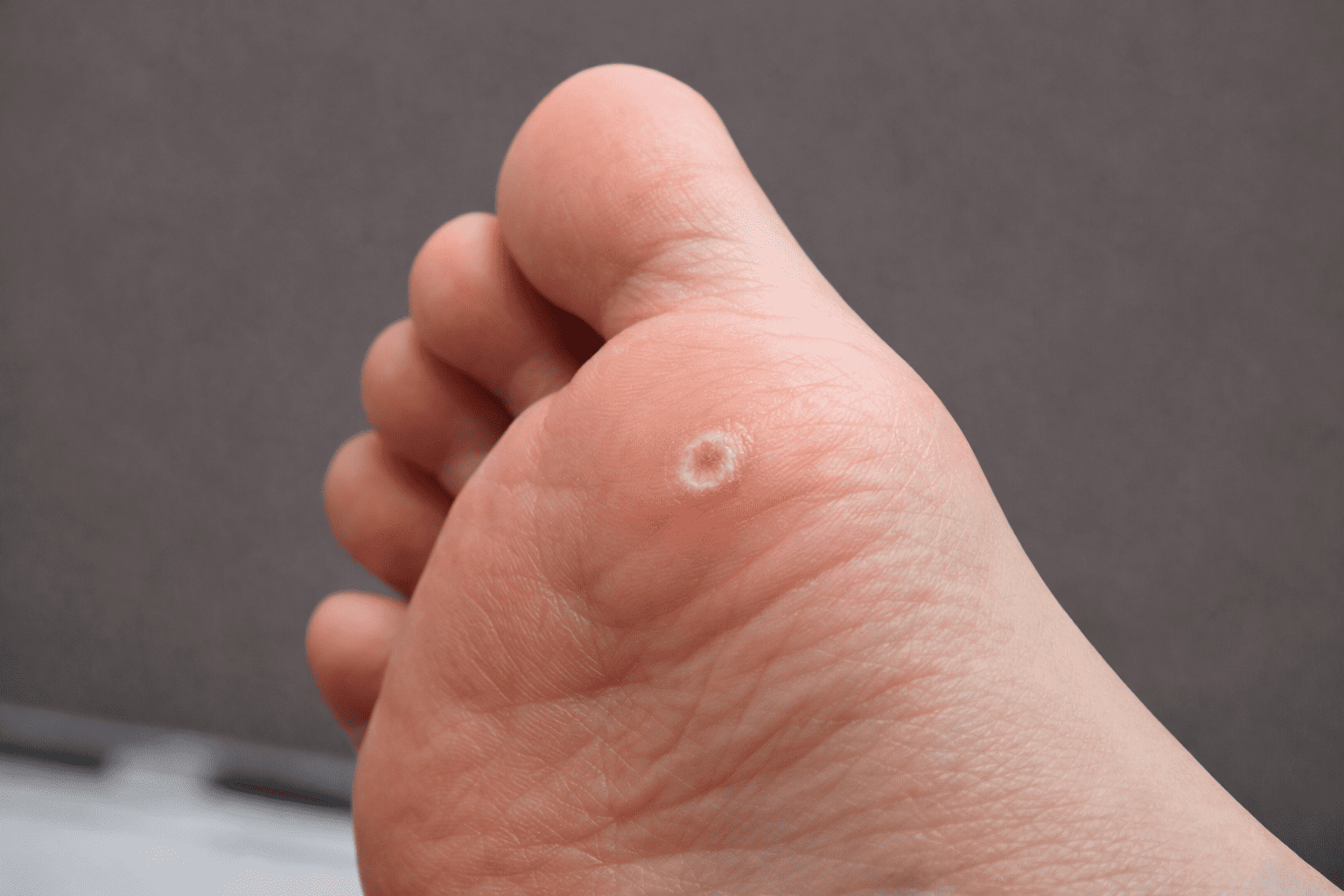 Pé acometido com verruga plantar (olho de peixe)