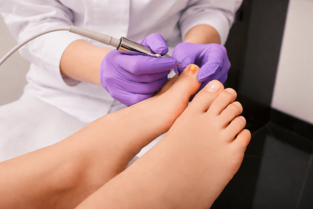 Tratamento de Micose de Unha com Laser em Campinas